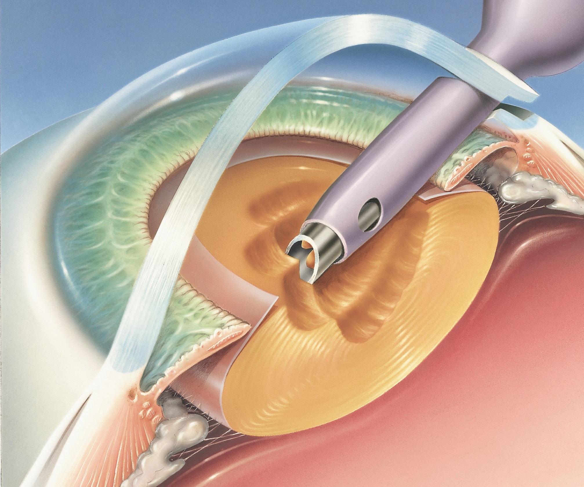 Cataract-Surgery1-2-1.jpg